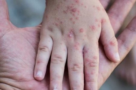 Qızılcadan ölən uşaqların sayı artır: Epidemik vəziyyət yarana bilər? - AÇIQLAMA