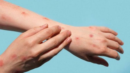 Təhlükə qapıda: meymunçiçəyinin ən təhlükəli variantı sürətlə yayılır